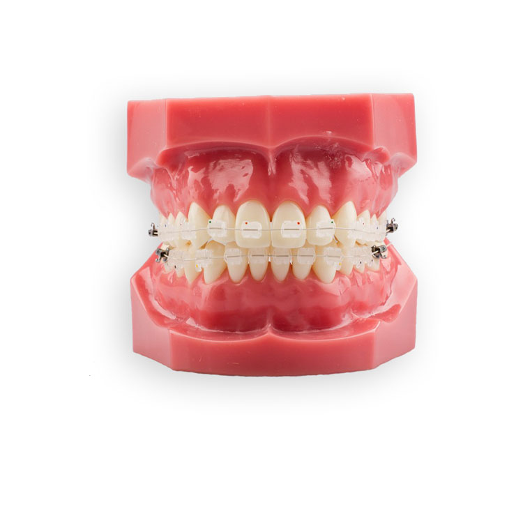 Ceramic Bracket Patient Kit